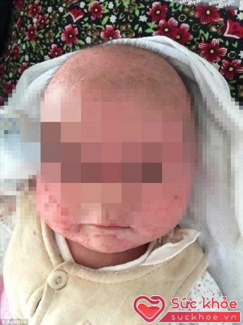Em bé đã được đưa đến một bệnh viện lớn ở Chiết Giang, Trung Quốc điều trị sau khi bị sốt cao trong nhiều ngày.