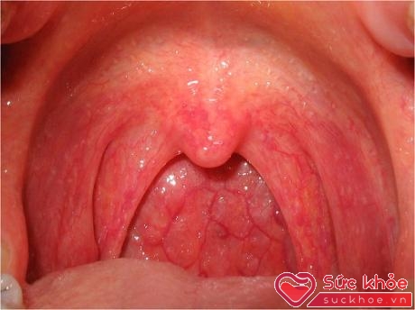 Triệu chứng của bệnh viêm họng do virut: phần miệng hầu bị sưng phồng và đỏ tấy lên