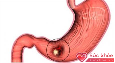 Chế độ ăn uống, sinh hoạt không hợp lý có thể dẫn đến các vấn đề dạ dày