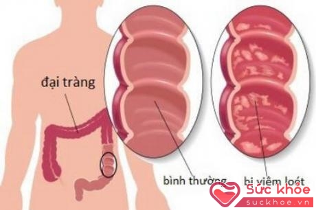 Khi bị viêm đại tràng, cần đi khám và tuân thủ điều trị của bác sĩ chuyên khoa