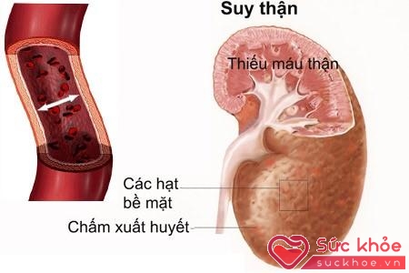 Bệnh thận ảnh hưởng đến tâm, sinh lý trong sinh hoạt tình dục.