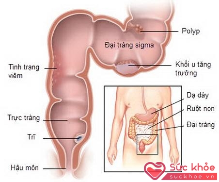 Viêm đại tràng xích - ma gây ảnh hưởng không nhỏ đến sức khỏe người bệnh