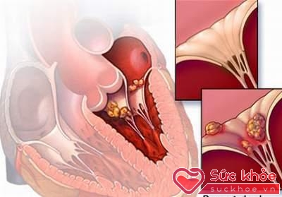 Giai đoạn 2 là giai đoạn tự miễn của bệnh viêm cơ tim