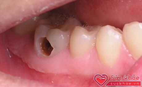 Sâu răng là bệnh thường gặp nhưng cần phải điều trị sớm để tránh biến chứng