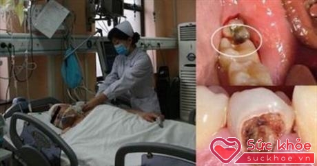 Người đàn ông 40 tuổi ở Trung Quốc đã mất mạng chỉ vì chủ quan với chiếc răng sâu