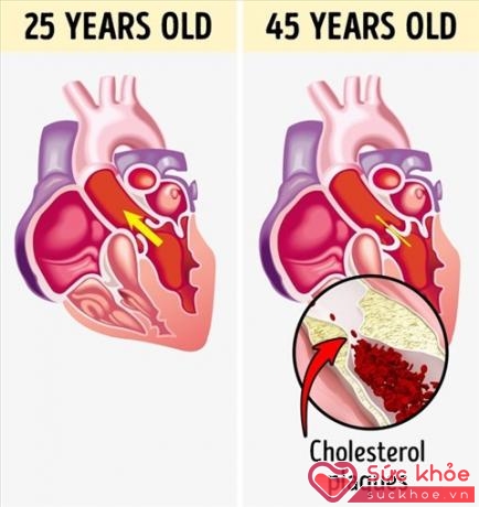 Hình ảnh thể hiện sức khỏe tim mạch ở tuổi 25 và tuổi 45, các mạch máu bị tắc nghẽn.