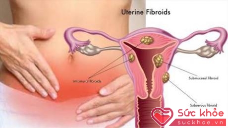 U xơ tử cung là khố u phát triển bất thường trong hoặc trên tử cung của người phụ nữ