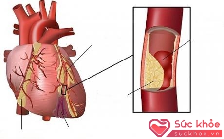 Triglyceride máu cao làm xơ vữa động mạch gây nguy cơ bệnh mạch vành và gan nhiễm mỡ.