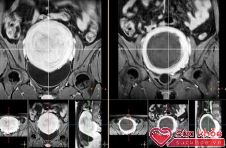 Khối u xơ tử cung của bệnh nhân bị suy tim đã được làm hoại tử bằng sóng siêu âm