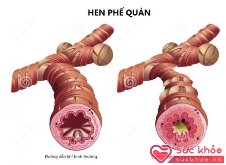 Ở người bệnh hen khi không gắng sức đã khó thở thì khi QHTD càng khó thở hơn do thiếu ôxy.