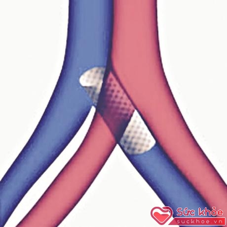 Tĩnh mạch chậu trái sau khi được nong và đặt stent