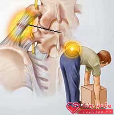 Bê vật nặng đúng tư thế giúp phòng ngừa đau cột sống thắt lưng.