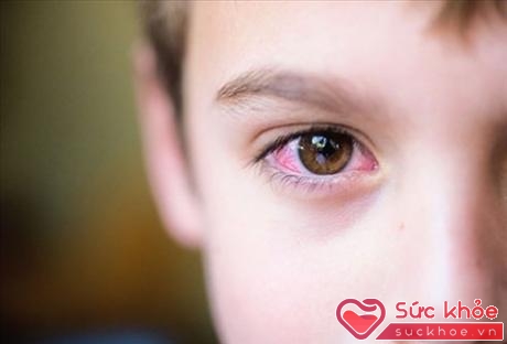 Hiện tượng đỏ mắt xảy ra khá thường xuyên khi bạn thức dậy vào sáng sớm hay khi vô ý bắn nước vào mắt trong khi tắm.