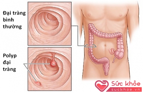 Đau bụng, đại tiện có máu, đi ngoài phân lỏng...là những dấu hiệu thường gặp khi bị polyp đại tràng