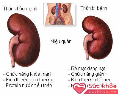 Âm suy hỏa vượng sinh chứng mất ngủ: bắt nguồn từ thận yếu.