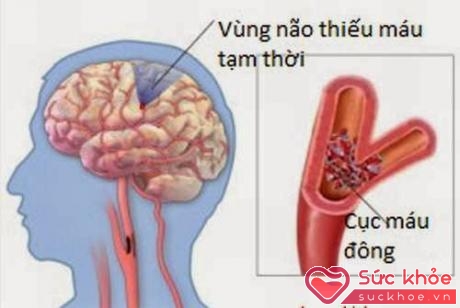 Cục máu đông làm nghẽn mạch là nguyên nhân chính gây tai biến mạch máu não.