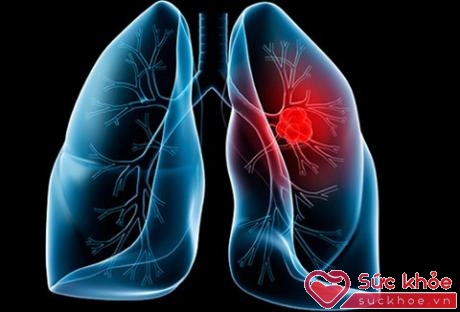 Ung thư phổi ở phụ nữ khác với loại ung thư phổi ở nam giới
