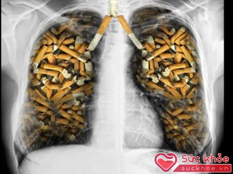 Thuốc lá là nguyên nhân gây hơn 90% ca tử vong vì ung thư phổi