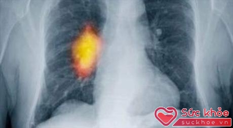 Ung thư phổi trên phim X-quang