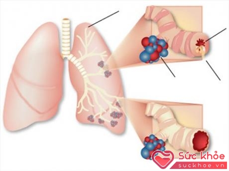 Triệu chứng xuất hiện của ung thư phổi có thể là biểu hiện của biến chứng