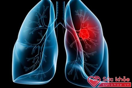 Ung thư phổi thường được phát hiện muộn, gây khó khăn trong điều trị