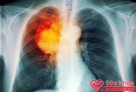 Những dấu hiệu như ho, tính khí thất thường, đau ngực đau vai, sụt cân... rất có thể là biểu hiện cảnh báo sớm của ung thư phổi