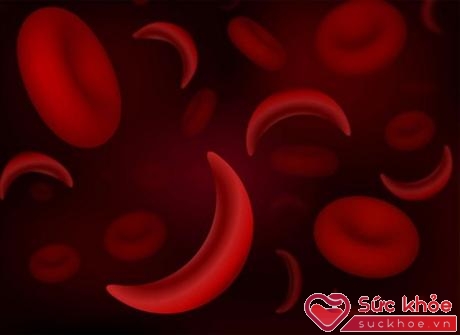 Những người có tế bào hồng cầu hình liềm có những tế bào hồng cầu thuôn dài trông giống như lưỡi liềm hoặc có hình chữ C.