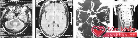 Hình ảnh chụp MRI và CTA của bệnh nhân Nguyễn Huy B không thấy bất thường.