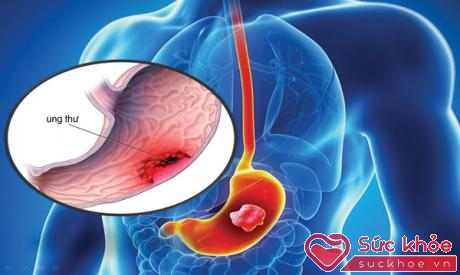 Sử dụng thuốc ức chế bơm proton với liều cao hay trong thời gian dài sẽ gia tăng nguy cơ ung thư dạ dày