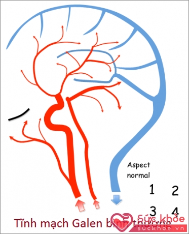 So sánh 2 trạng thái của Tĩnh mạch Galen (Ảnh minh họa )