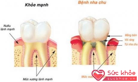 Viêm nha chu là bệnh lý răng miệng thường gặp hiện nay.