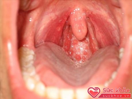 Bệnh lây truyền qua đường tình dục sẽ dễ dàng trú ngụ trong các mô mềm, ẩm ở mặt sau của miệng, cổ họng nhiều hơn bạn tưởng.