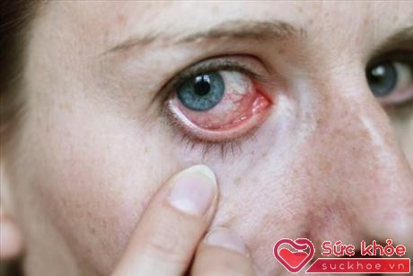 Bệnh lây truyền qua đường tình dục có thể gây ra nhiễm trùng mắt như Herpes, lậu, chlamydia và giang mai.