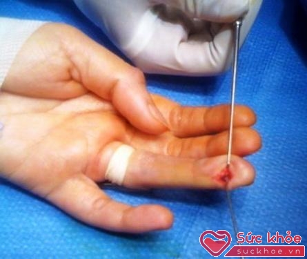 Hình ảnh u cuộn mạch búp ngón tay.