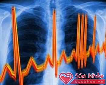 Điện tâm đồ nhịp tim nhanh trong hội chứng cổ - tim.