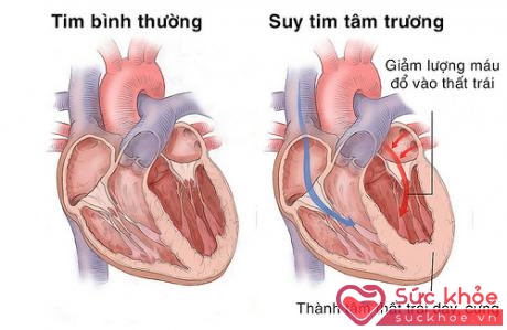 Suy tim có thể gây nhiễu loạn tâm thần ở người cao tuổi.