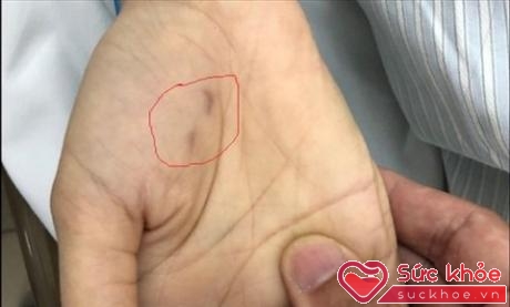 Vết cắn trên tay nữ BS thú y tử vong vì bệnh dại. Ảnh: Phương Linh.