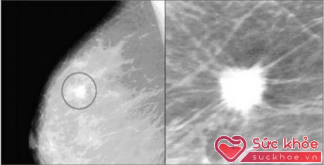 Hình ảnh nốt vôi hóa tuyến vú trên phim Xquang