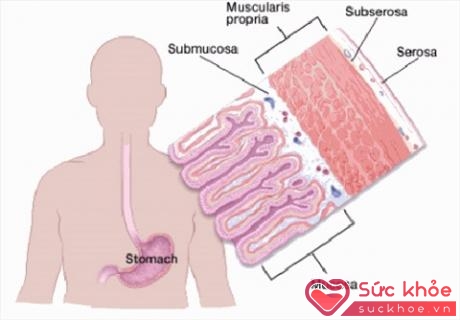 Sự xâm lấn của các tế bào ung thư trong niêm mạc dạ dày 