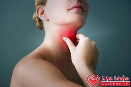 Hạch ở cổ trong bệnh ung thư vòm họng có thể xuất hiện rất sớm ngay trong giai đoạn đầu của bệnh. 
