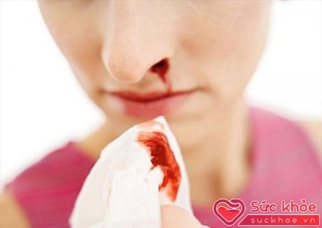Chảy máu cam có thể là dấu hiệu của ung thư vòm họng 