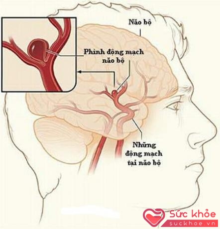Phình động mạch não - Một trong những nguyên nhân gây đau đầu.