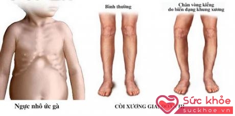 Trẻ bị còi xương do thiếu vitamin D.