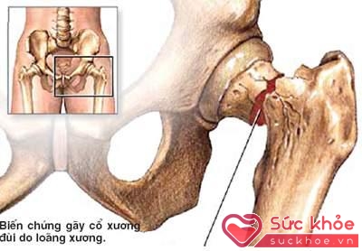 Gãy cổ xương đùi là một biến chứng nặng nề nhất ở người cao tuổi do loãng xương.
