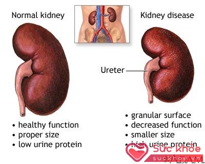 Dấu hiệu suy thận (phải): bề mặt lổn nhổn, suy giảm chức năng, kích thước nhỏ hơn, protein nước tiểu cao