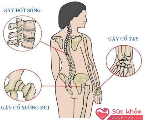 Những vị trí hay bị gãy do loãng xương.