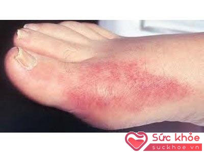 Hình ảnh dấu hiệu bệnh Gout