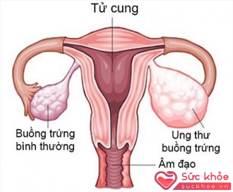 Sự khác nhau giữa buồng trứng bình thường và buồng trứng bị ung thư