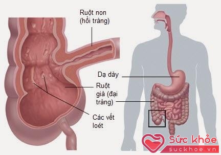 Viêm ruột do bệnh Crohn