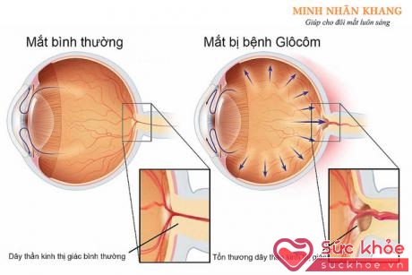 Tự ý lạm dụng thuốc nhỏ mắt dễ bị các biến chứng: tổn thương thần kinh thị giác glaucoma.